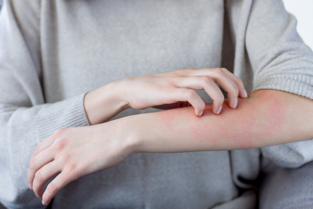 Woman scratching a rash on her arm